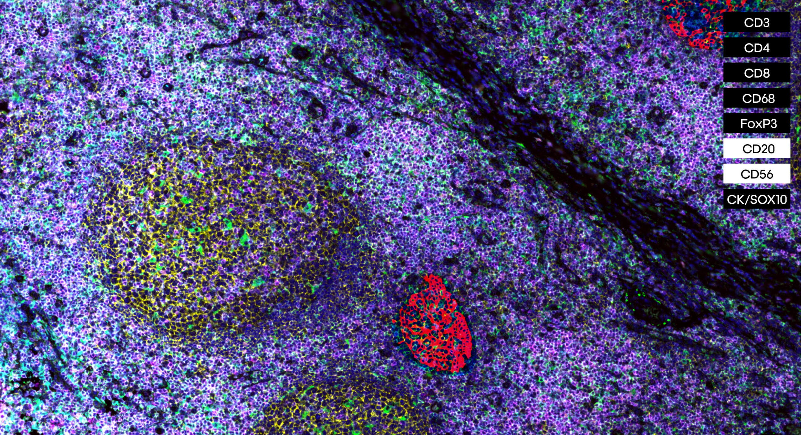 Tumor Infiltrating Lymphocyte (TIL) panel