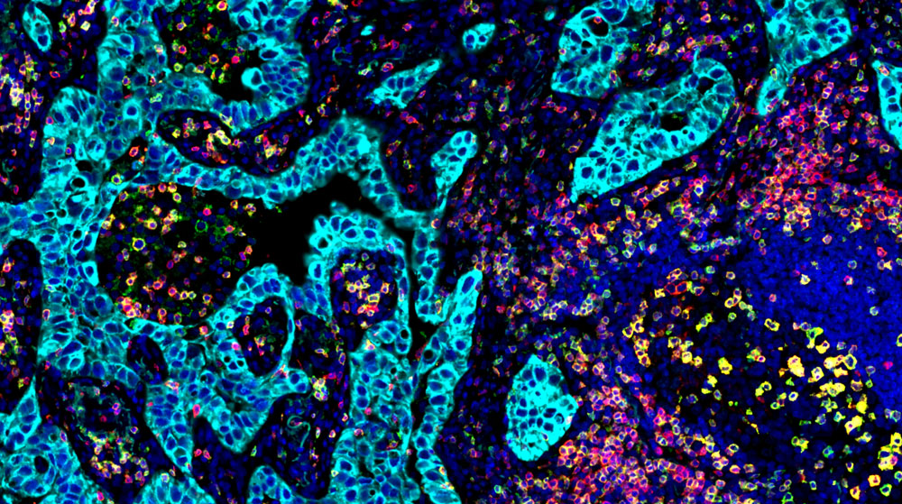 OmniVUE (formerly FixVUE) PD1 panel (non-small cell lung cancer)