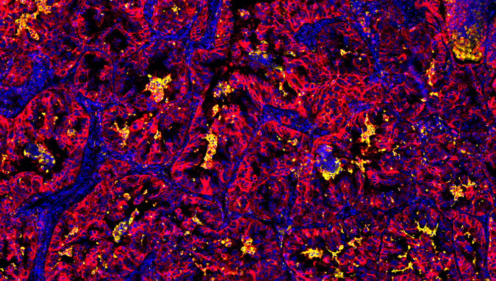 OmniVUE (formerly FixVUE) PDL1 panel (non-small cell lung cancer)
