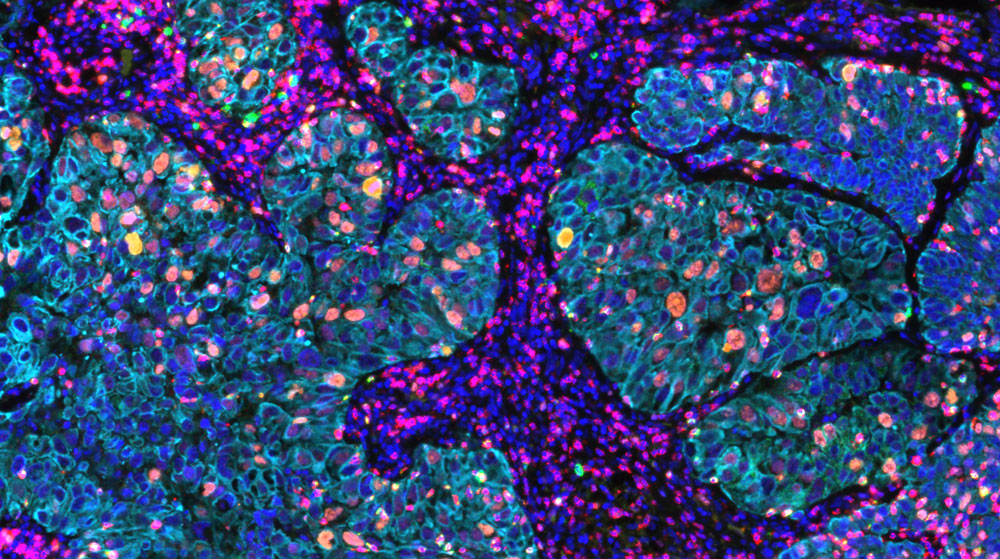 OmniVUE (formerly FixVUE) T-act panel (non-small cell lung cancer)