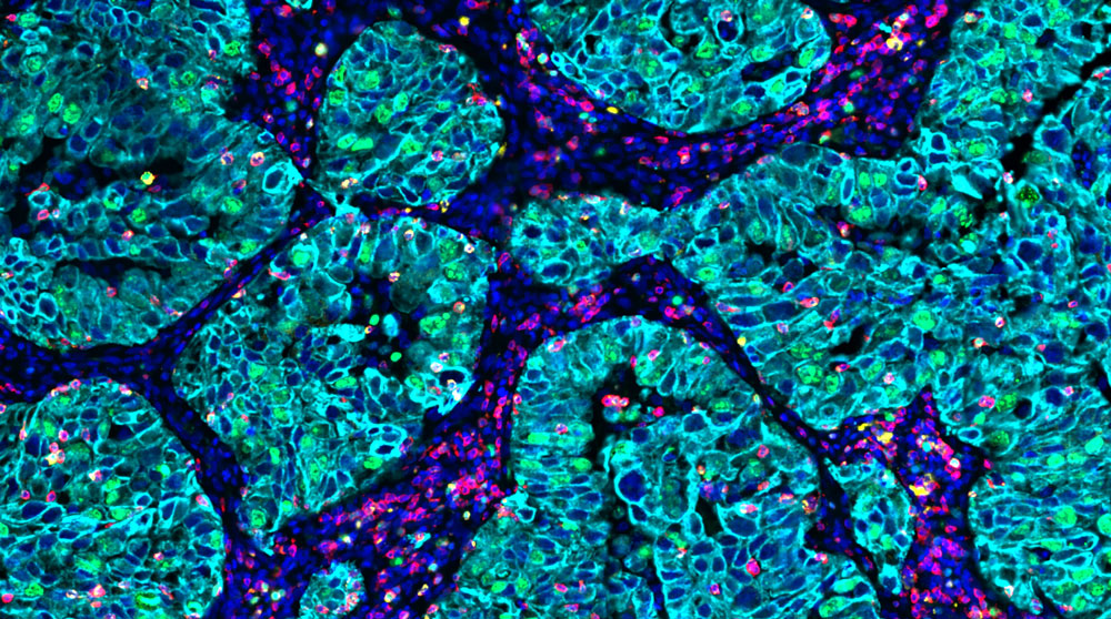 OmniVUE (formerly FixVUE) T-act panel (non-small cell lung cancer)